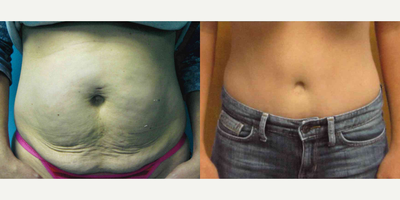 Tummy Tuck before and after photo