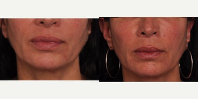 Dermal Fillers before and after photo