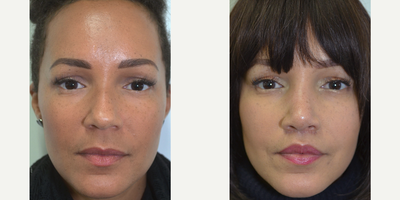 Rhinoplasty before and after photo