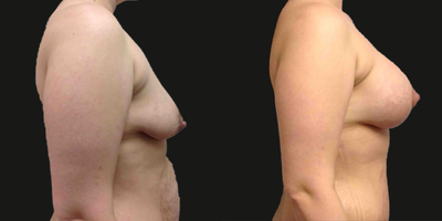 Breast Lift with Implants before and after photo