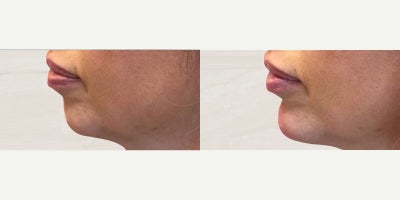 Chin Filler before and after photo