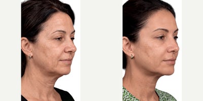Deep Plane Facelift before and after photo