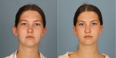 Ear Surgery before and after photo