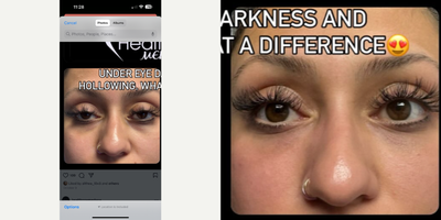 Juvederm before and after photo