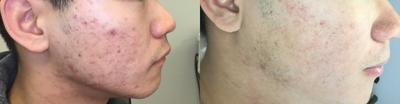 Microneedling before and after photo