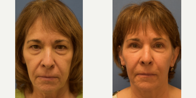 Sculptra before and after photo