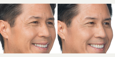 Botox before and after photo