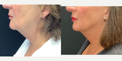 FaceTite before and after photo