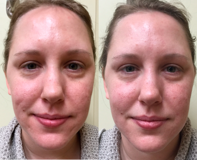 Juvederm before and after photo
