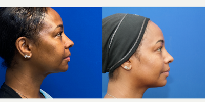 Liposuction before and after photo