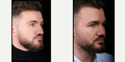 Revision Rhinoplasty before and after photo