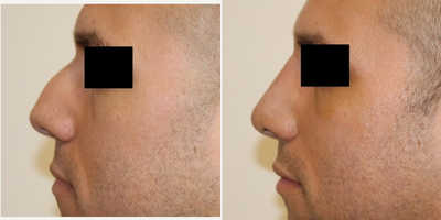 Rhinoplasty before and after photo