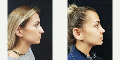 Rhinoplasty before and after photo
