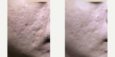 Scar Removal before and after photo