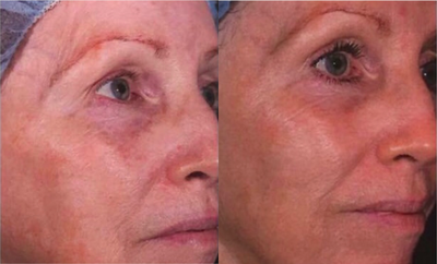 Skin Rejuvenation before and after photo