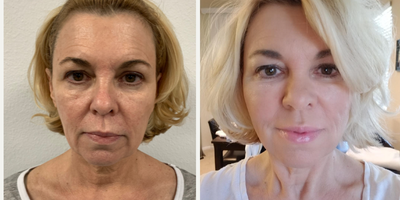 Thread Lift before and after photo