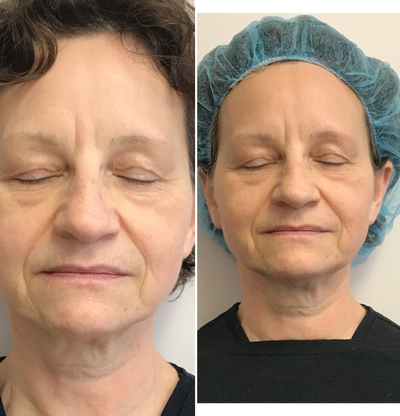 HydraFacial before and after photo
