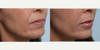Juvederm before and after photo