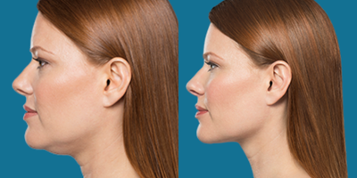 Kybella before and after photo