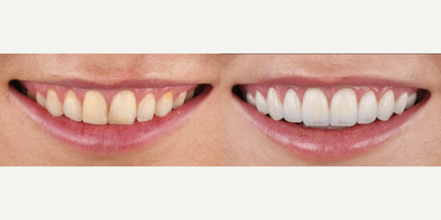 Porcelain Veneers before and after photo