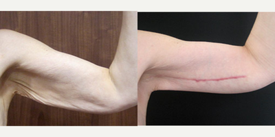 Arm Lift before and after photo