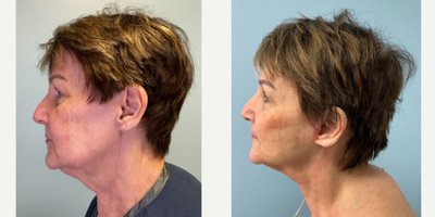 before and after image