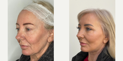 Neck Lift before and after photo