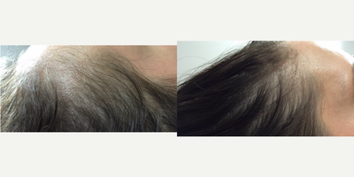 PRP for Hair Loss before and after photo