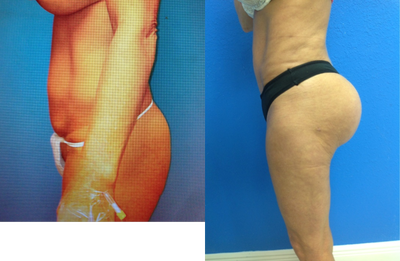 Butt Augmentation before and after photo