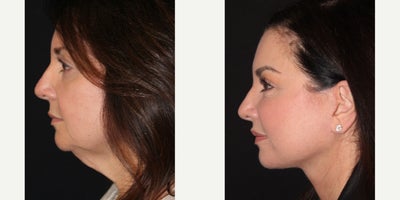 Deep Plane Facelift before and after photo