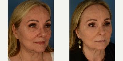 Eyelid Surgery before and after photo