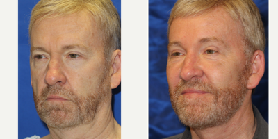 Facial Fat Transfer before and after photo