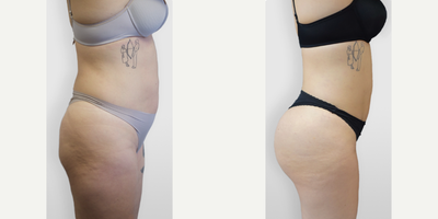 Laser Liposuction before and after photo