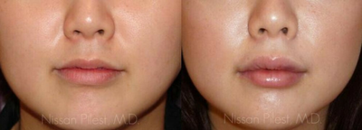 Lip Fillers before and after photo