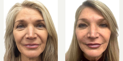 Botox before and after photo
