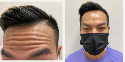 Botox before and after photo