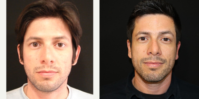 Ear Surgery before and after photo
