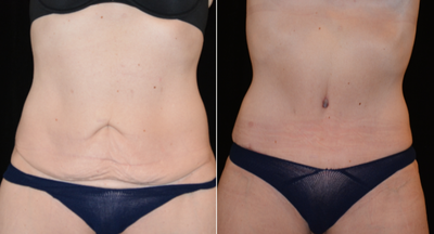 Tummy Tuck before and after photo