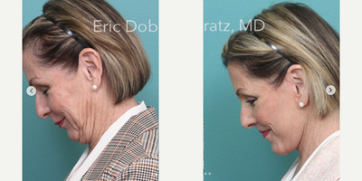 Neck Lift before and after photo