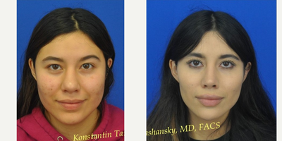 Revision Rhinoplasty before and after photo