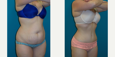 Tummy Tuck before and after photo
