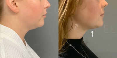 AirSculpt+ before and after photo