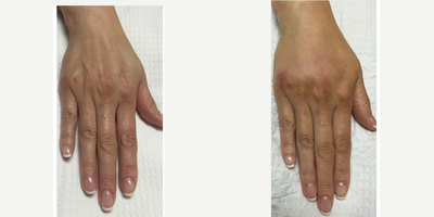 Hand Rejuvenation before and after photo