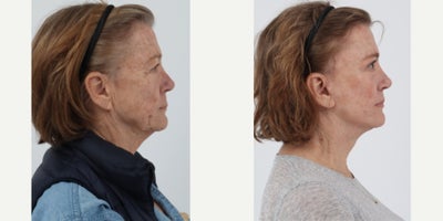 before and after image