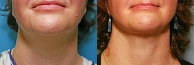 Liposuction before and after photo
