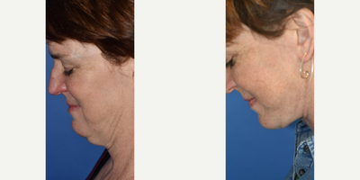 Eyelid Surgery before and after photo
