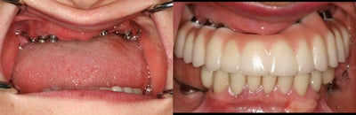 Dental Implants before and after photo
