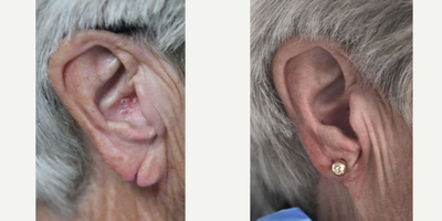Earlobe Repair before and after photo