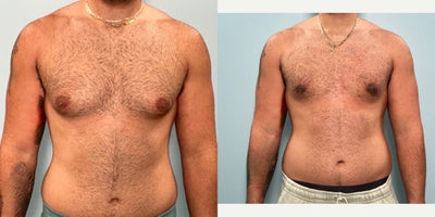 Gynecomastia Surgery before and after photo