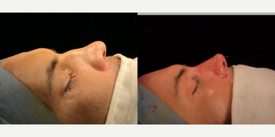 Revision Rhinoplasty before and after photo